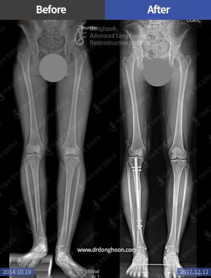 Leg Length Discrepancy – Limb Lengthening & Complex Reconstruction ...