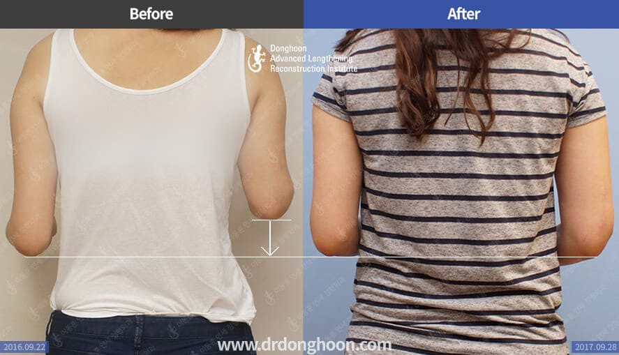 Arm Lengthening Limb Lengthening & Complex Reconstruction Service