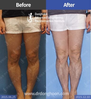 Bowlegs – Limb Lengthening & Complex Reconstruction Service: Korea | DALRI